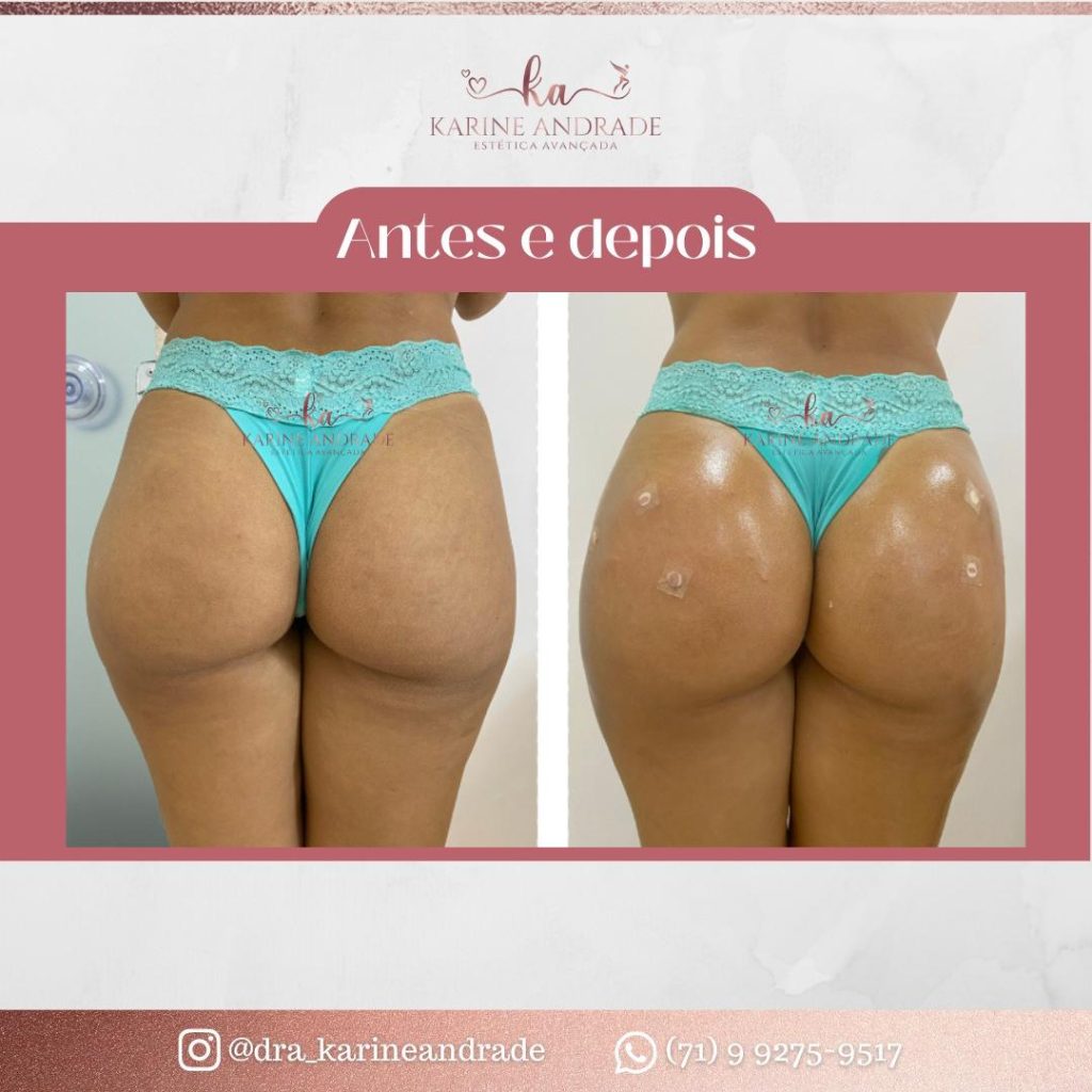 A busca pelo bumbum perfeito vai além da estética